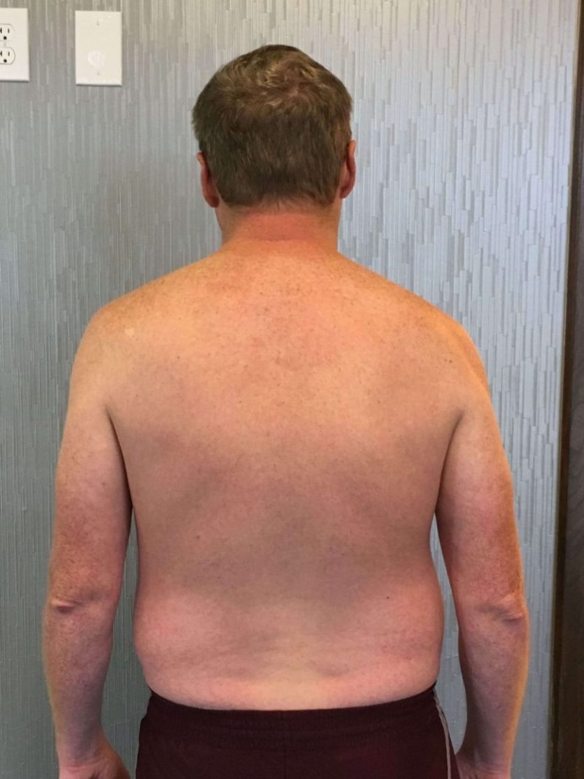 Client Bryan Reeves before picture showing his back